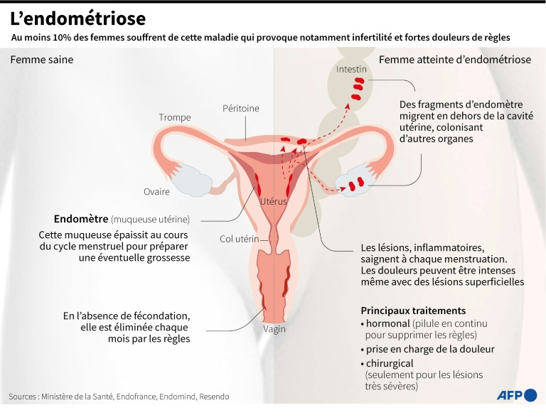 L'endométriose