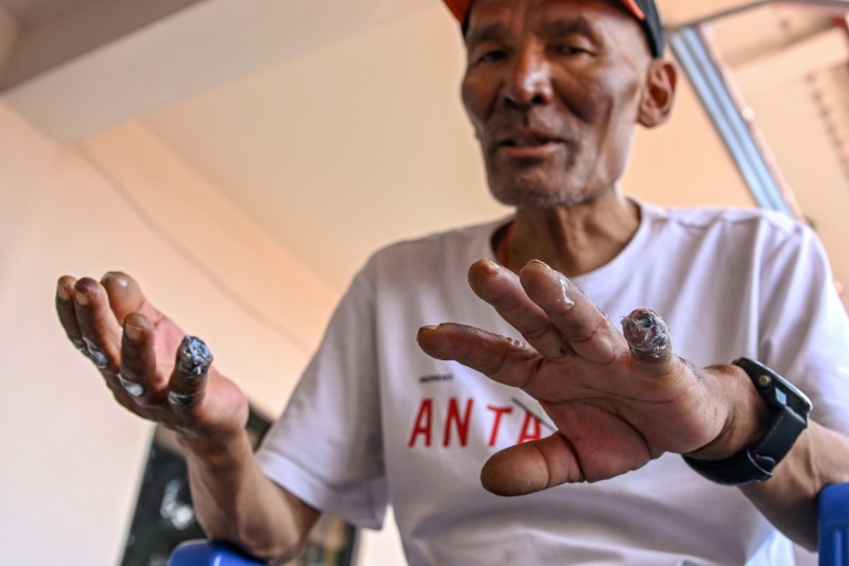 Le miraculé de l'Everest Dawa Sherpa montre le résultat de ses engelures aux mains lors d'un entretien accordé à l'AFP à Katmandou le 18 juin 2026