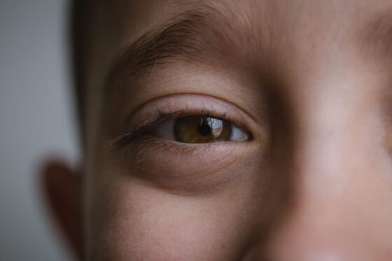 Sécheresse, irritations, brûlures… Nos yeux souffrent aussi de la chaleur