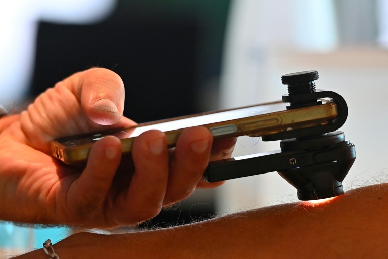 Un kiné utilise un smartphone et un dermascope pour repérer des mélanomes, le 26 septembre 2026, à Montpellier dans l'Hérault